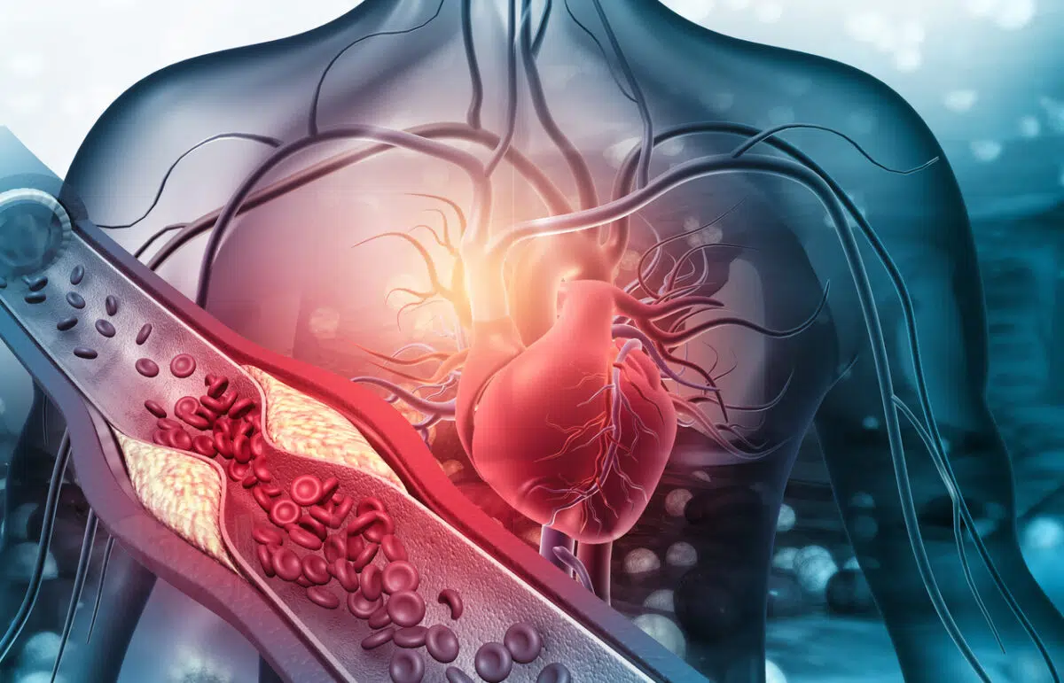 Heart, blocked arteries