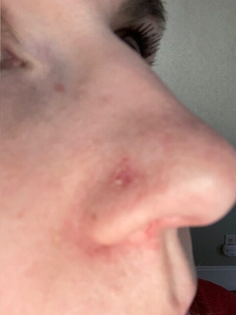 Skin Cancer and Mohs Surgery