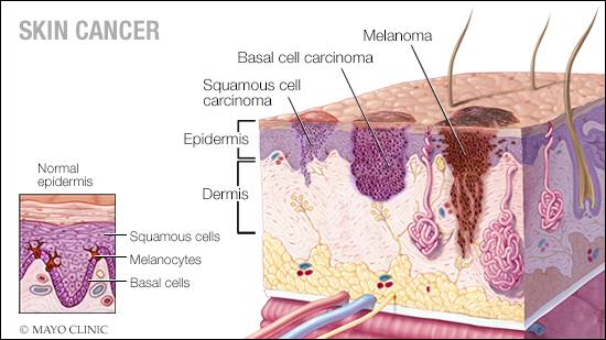 skin cancer diagram - Mayo Clinic