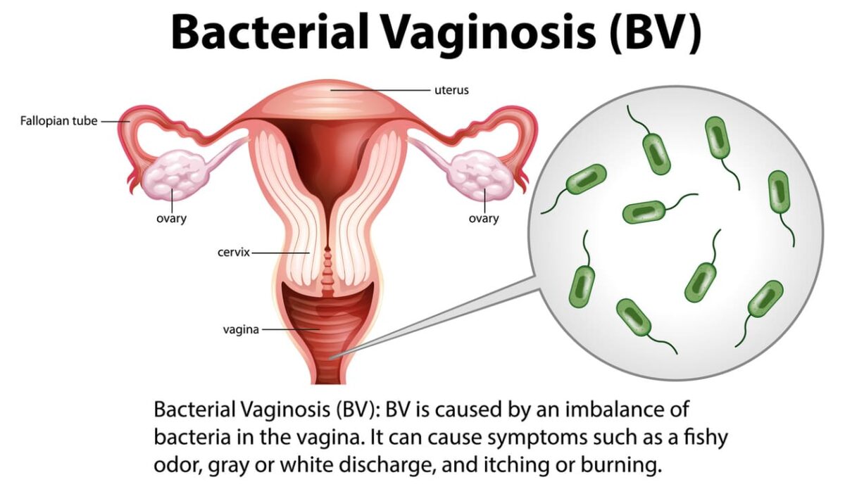 Bacterial Vaginosis