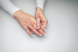 8 Best Eczema Treatments for Dry, Inflamed Skin