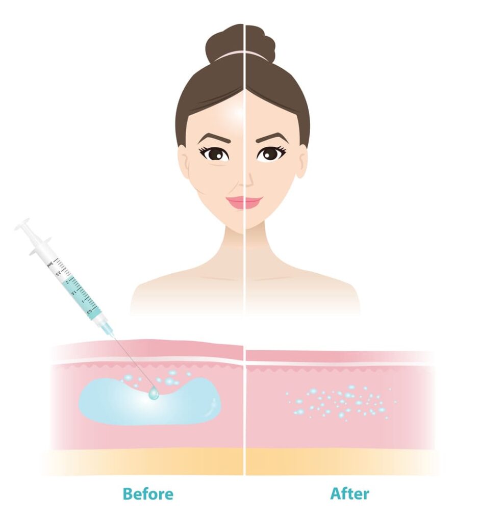 Dissolving fillers graphic