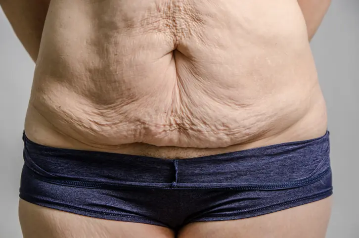 Close up on excess of a woman's belly skin after losing lots of weight. Is skin removal after weight loss worth it?