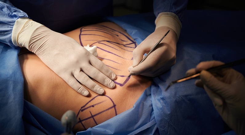 Close up of plastic surgeon hands in sterile gloves using scalpel while doing plastic surgery in clinic. Concept of cosmetic surgery and abdominoplasty. Types of skin removal procedures after weight loss.
