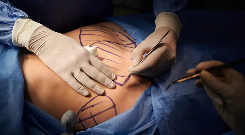 Close up of plastic surgeon hands in sterile gloves using scalpel while doing plastic surgery in clinic. Concept of cosmetic surgery and abdominoplasty. Types of skin removal procedures after weight loss.