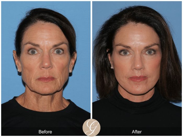 Deep Plane Facelift Before and After 2