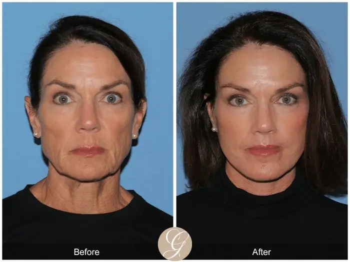 Deep Plane Facelift Before and After 2