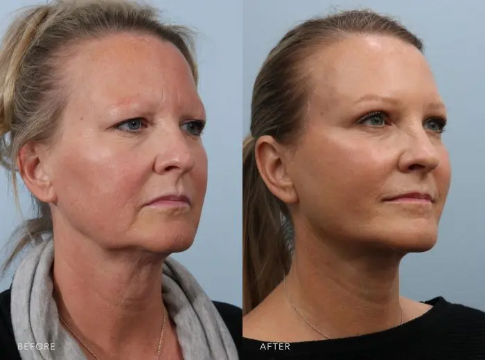 Deep Plane Facelift Before and After